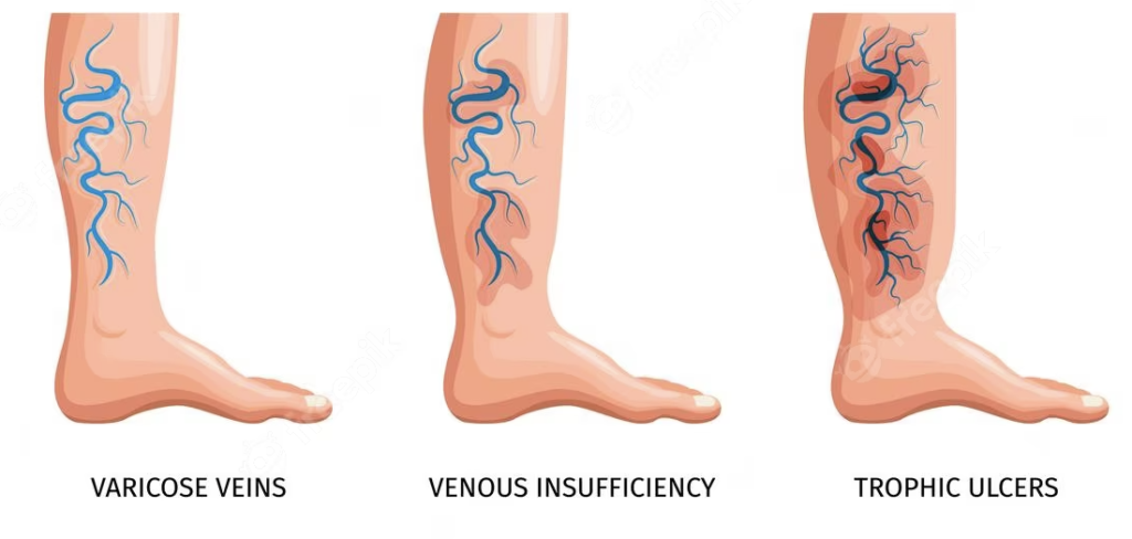 Venous diseases