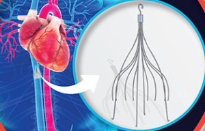 IVC Filter / IVC Filter Removal - Amarillo Heart Institute